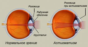 astigmatizm1
